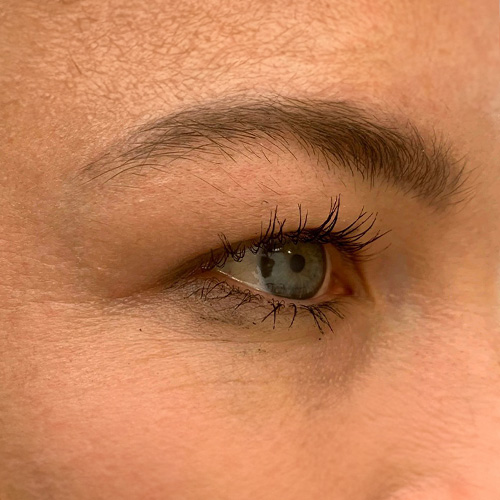 03-After Plasma Skin Tightening Belle Skin and Artistry