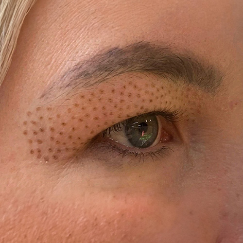 03-Before Plasma Skin Tightening Belle Skin and Artistry