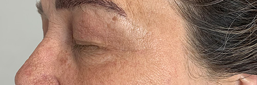 09-After Profosma Jet Plasma Belle Skin and Artistry