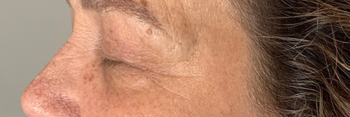Before Profosma Jet Plasma Belle Skin and Artistry