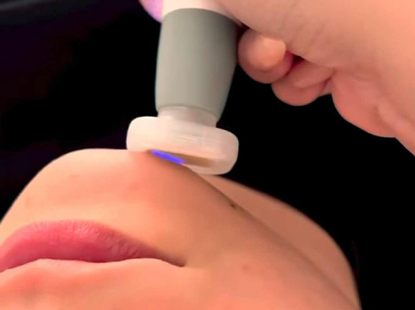 Belle Skin and Artistry Profosma-Jet-Plasma.jpg